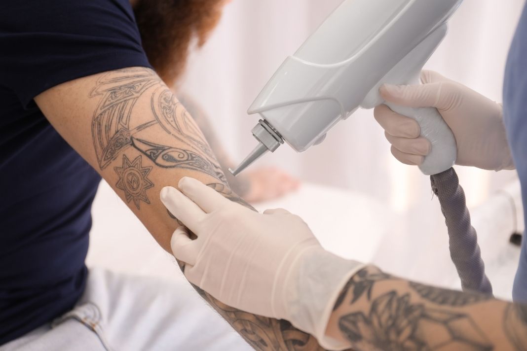 Free tattoo removal for job seekers Inkjunx