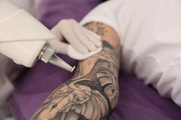 Hoe ver gaat de technologie om tatoeages te verwijderen?